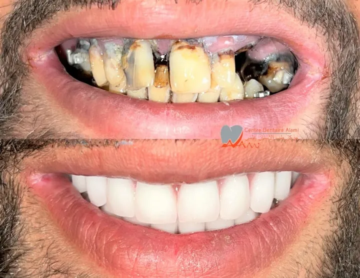 Reconstruction esthétique complète