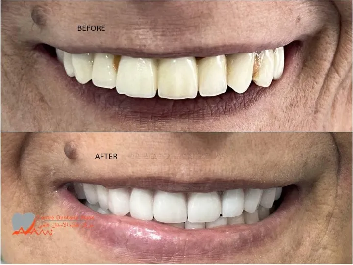 Facettes composite esthétiques