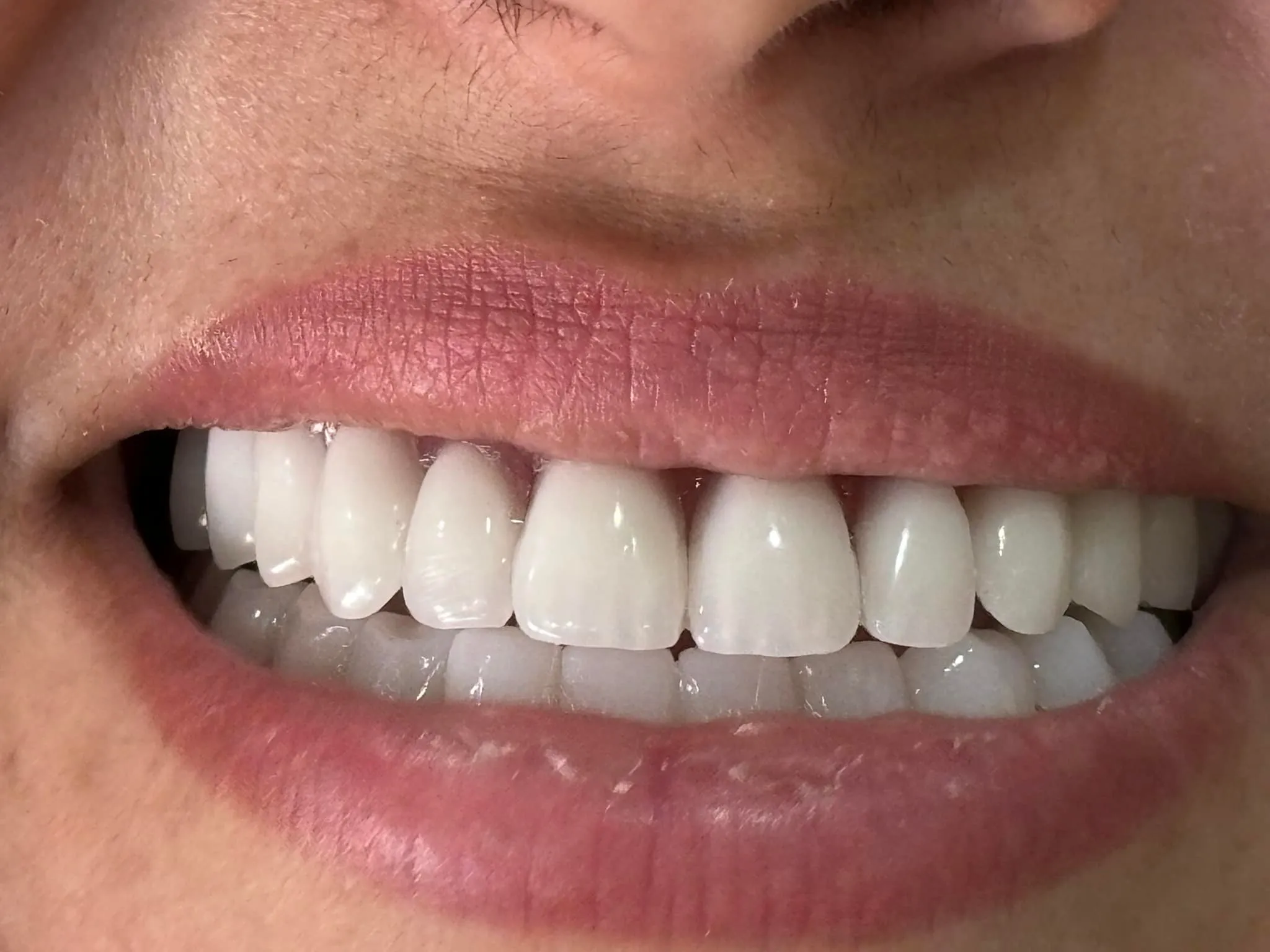 Gingivectomie esthétique