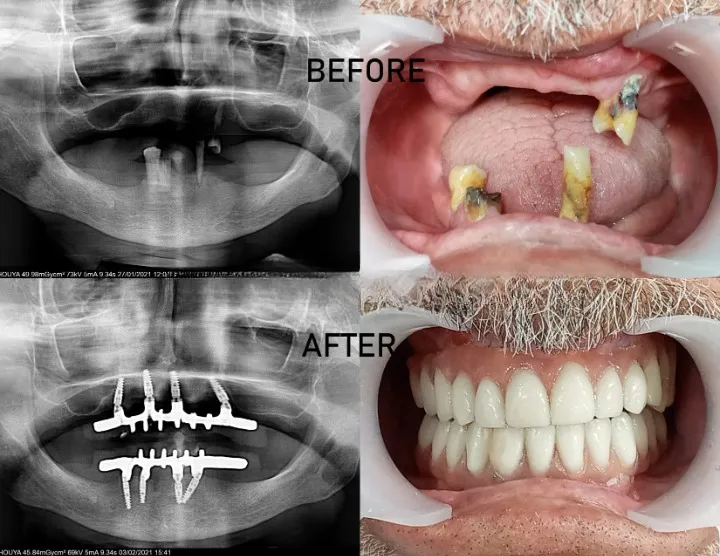 Détartrage et surfaçage
